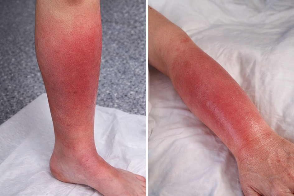 Erysipel bei Lymphödem – Prophylaxe